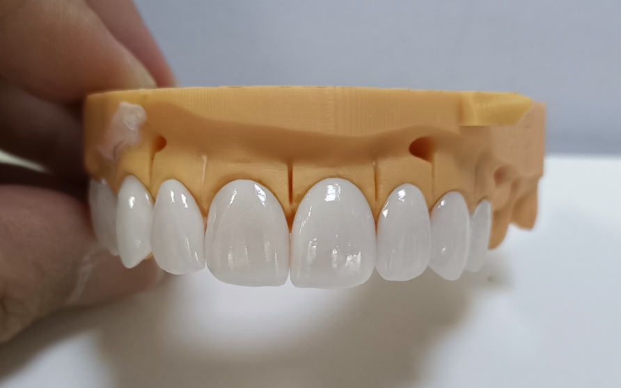 Veneer Emax Estetika Tinggi