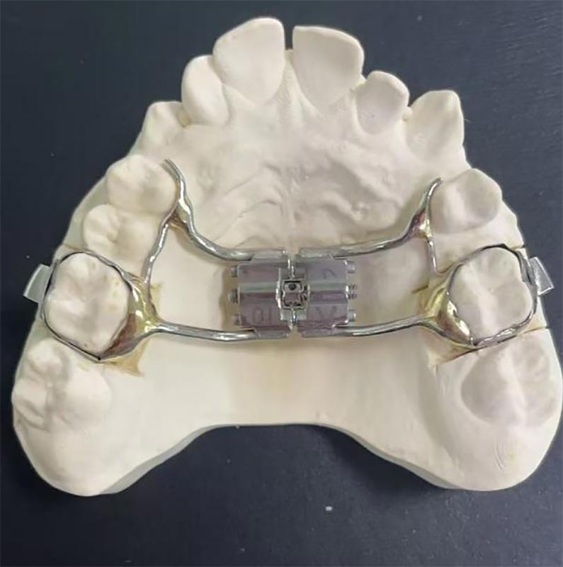 Apa itu Expander Maxillary Rapid (RME)?