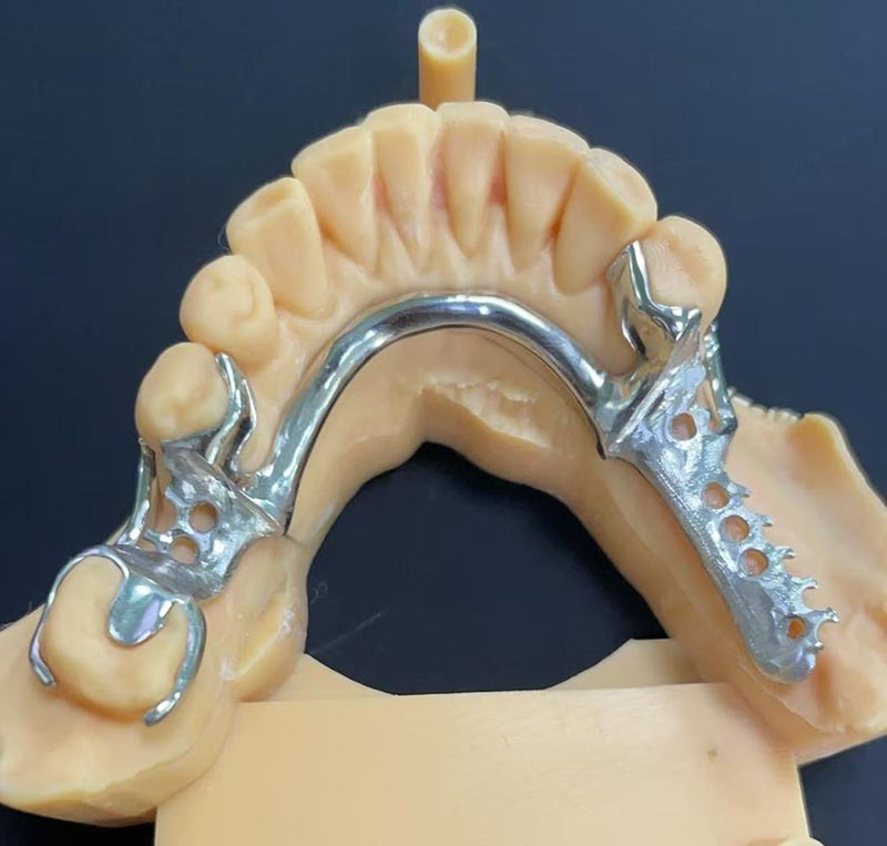Keuntungan Kerangka Cobalt-Chromium (Kerangka Co Cr)