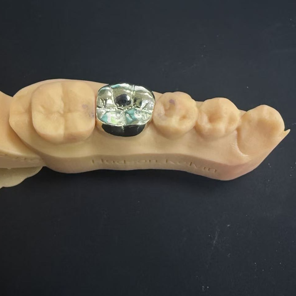 Mahkota Emas: Pilihan Logam Mulia untuk Restorasi Gigi Seumur Hidup