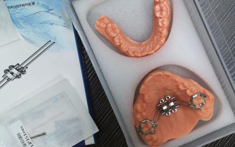 Pahami Ekspansi Kerangka MSE dengan WM Dental Lab