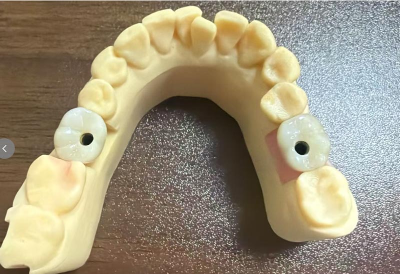 Mengapa Implantasi Gigi Depan Lebih Sulit Dibanding Implantasi Gigi Posterior?