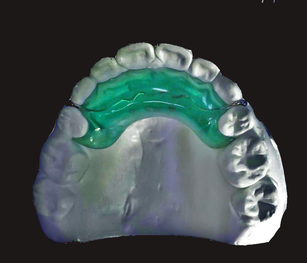 Bidang Gigitan Cenderung Anterior