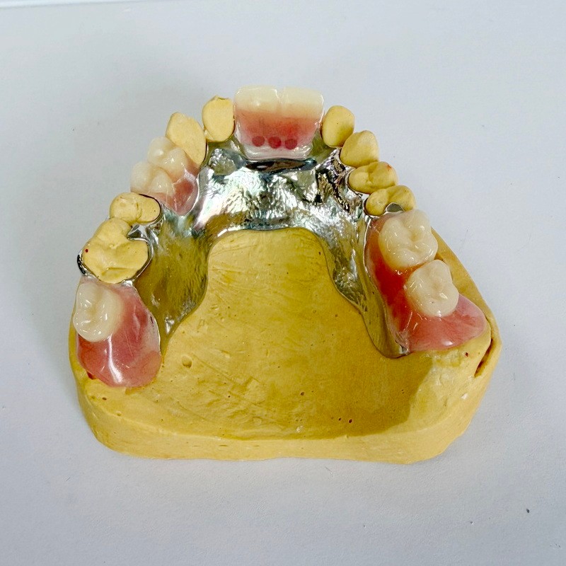 Kerangka Parsial Restorasi yang Dapat Dilepas